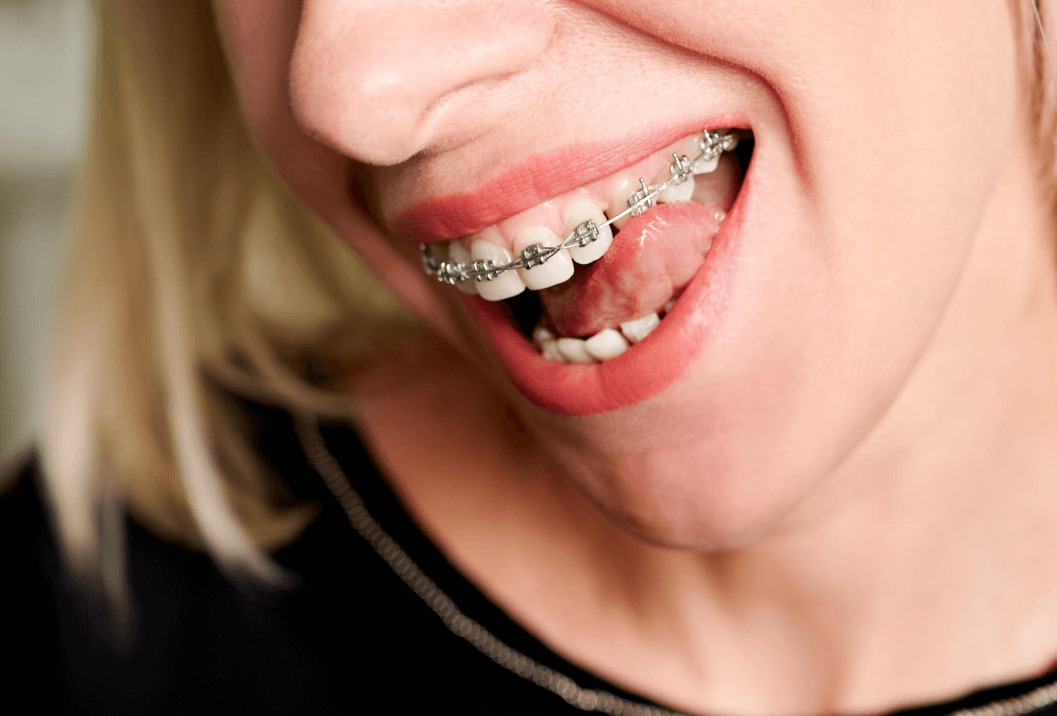 Cuanto cuesta ponerse brackets